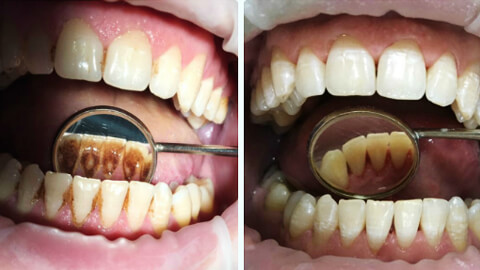 Стоматология: почему следует избавиться от зубного камня - фотография